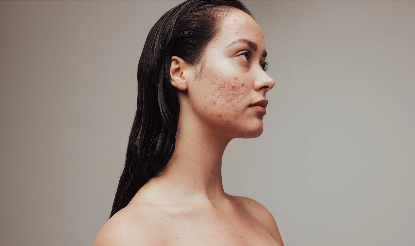 5 Things You Didn’t Knew About Acne